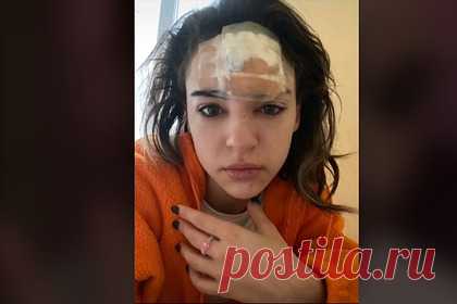 Девушка выдавила прыщ и осталась с опухолью на голове. Блогерша выдавила прыщ на лбу и попала в больницу. На размещенных в сети кадрах Тася объяснила, что решила избавиться от появившегося на лбу прыща и самостоятельно выдавила его руками. По ее словам, во время манипуляции из него начала выливаться прозрачная жидкость, и она поняла, что это оказался фурункул.