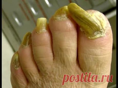 Как избавиться от грибка на Ногах, Ногтях,  и чтоб капыта не Воняли