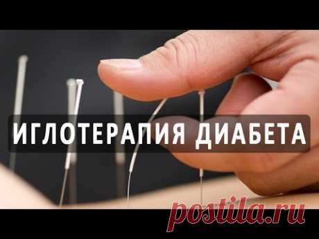 Иглоукалывание (акупунктура) при сахарном диабете