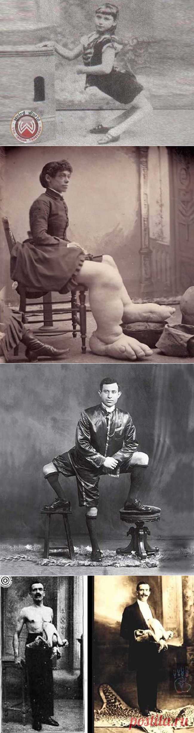 ФотоТелеграф » Трудно поверить, но эти 5 человек с аномалиями действительно существовали!