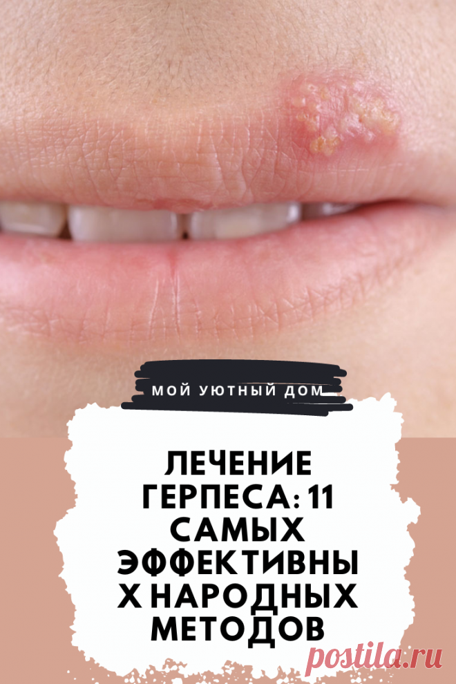 Лечение герпеса в домашних условиях