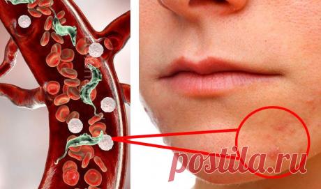 12 верных признаков, что ваше тело отравляют паразиты - Журнал для женщин Статистические данные Всемирной организации здравоохранения свидетельствуют, что практически все население земного шара заражено теми или иными видами паразитов, мельчайших организмов, которые обитают в теле человека и существуют за счет него. Медики назвали 12 признаков того, что в организме есть паразиты. Многие виды гельминтов находятся в теле человека и отравляют его продуктами жизнедеятельности ...