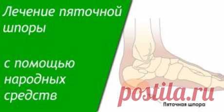Лечение пяточной шпоры с помощью народных средств | Полезные советы