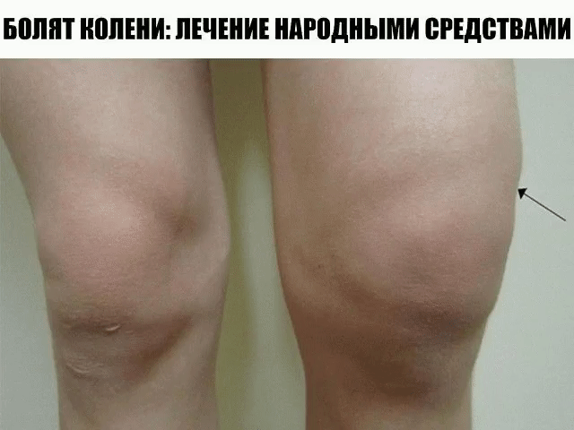 БОЛЯТ КОЛЕНИ: ЛЕЧЕНИЕ НАРОДНЫМИ СРЕДСТВАМИ    
Если болят колени, нужно взять лист хрена, окунуть в кипяток, приложить на 2-3 часа к коленям. Листья хрена хорошо вытягивают соли и боль проходит. Курс лечения – 7 дней. 
Если травмированы суставы на ногах: на ночь делать компрессы из раствора хозяйственного мыла. 
Возьмите денатурат и керосин в равных пропорциях, слейте в стеклянную банку, положите туда 3-4 стручка свежего жгучего перца. Банку плотно закройте, поставьте настаиваться в теплое