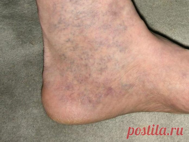 У всех дома есть это средство от варикоза, но никто о нем не знает