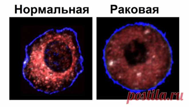 Рак – это общее название для обширной группы онкологических заболеваний, при которых клетки тела начинают бесконтрольный рост и деление .Все типы рака начинаются, когда клетки тела начинают расти бесконтрольно. Вместо того, чтобы умереть, раковые клетки продолжают расти и размножаться. У клеток рака, в отличие от нормальных клеток, существует способность вторгаться в другие ткани, постепенно увеличивая размеры опухоли.