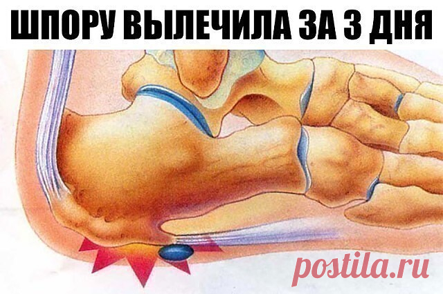 ШПОРУ ВЫЛЕЧИЛА ЗА 3 ДНЯ
Поделюсь рецептами от пяточных шпор. Прошлым летом на юге после ванн у меня так разболелась нога, что я не знала, куда ее деть. Пятка горела огнем. Приехав домой, побежала к хирургу. Молодая врач сделала снимок и объявила, что у меня после ванн обострилась пяточная шпора. Дала мне какую-то «памятку» - и все. Я поняла, что надо самой лечиться. Обратилась к народной медицине - стала искать рецепты от шпор. Все, что нашла, выписала и посылаю вам. Ведь ...