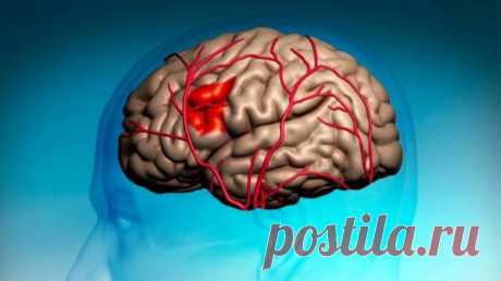 Как простая игла может спасти вам жизнь в случае инсульта? / Будьте здоровы