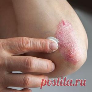 Псориаз проходит мгновенно если втирать перед сном...