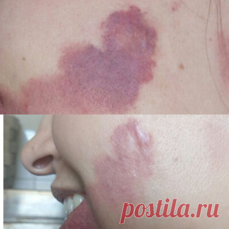 Лечение гемангиомы ⭐⭐⭐в центре Киева ✅ на Печерске 🔆 Более 8 лет опыта 🔝Врачи проходили стажировки в США 🇺🇸 Звоните ☎(068) 938 03 03