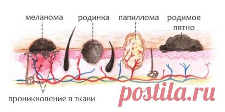 Как отличить родинку от папилломы | Мамам, женщинам, бабушкам и очень любознательным.