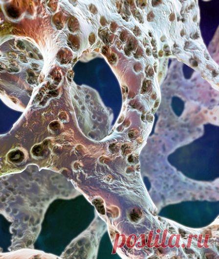 Польза народной медицины: лечим остеопороз.