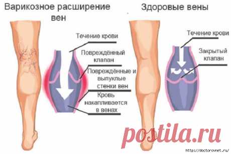 Чего боится варикоз: эффективные народные методы лечения