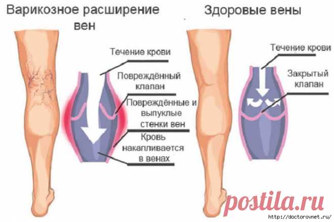 Чего боится варикоз: эффективные народные методы лечения