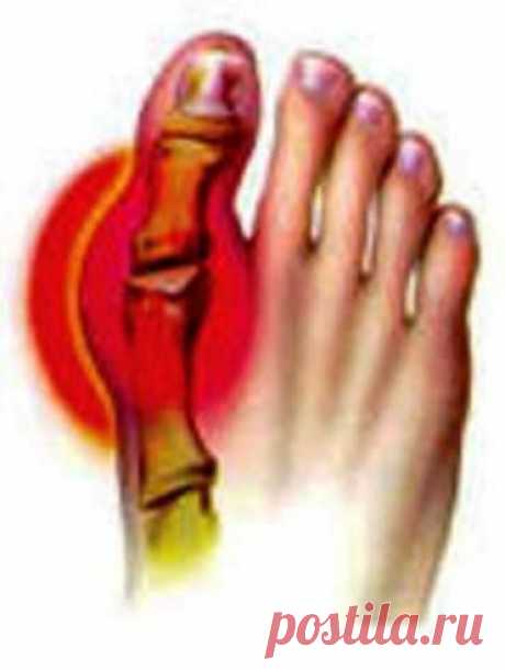 Лечение подагры народными средствами | vita-jizn.net
Лечение подагры народными средствами доступно каждому. Но прежде, чем начать лечение подагры народными средствами, нужно быть уверенным, что у Вас именно подагра.
6 рецептов народных средств, в том числе японских