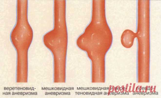 Коварное заболевание с непредсказуемым исходом — вот как говорят хирурги об аневризме. Аневризма — выпячивание стенок артерий или вен из-за их истончения или растяжения. Вследствие этого образуется аневризматический мешок, давящий на окружающие ткани.
