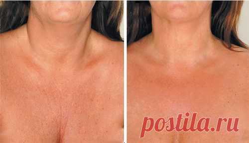 Как разгладить морщины в области декольте: натуральный уход - Шаг к Здоровью