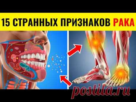 ВНИМАНИЕ! 15 ранних признаков рака, которые большинство людей пропускают! - Не игнорируйте!