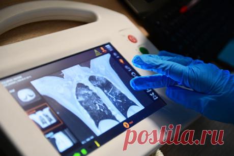 Российские ученые научились выявлять поражение легких у пациентов за 15 секунд. Якутские ученые с помощью искусственного интеллекта научились выявлять поражение легких у пациентов с COVID-19, на диагностику с использованием компьютерной томографии уходит 15 секунд. Эксперты надеются, что методика поможет спасти сотни жизней в случае ухудшения эпидемиологической ситуации.