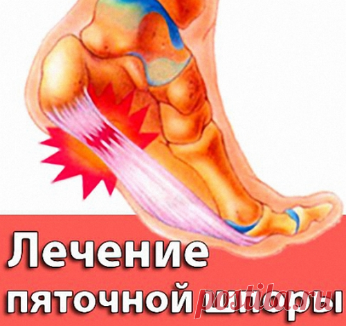 Как вылечить пяточную шпору в домашних условиях Как вылечить пяточную шпору в домашних условиях? Весьма эффективны мази, растирки из природных продуктов и растительных ингредиентов