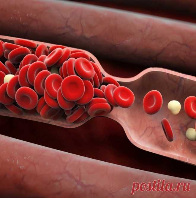 Опасность тромбоза вен и причины его возникновения Тромбоз вен — опасное заболевание: на первых стадиях люди не знают о его существовании. Существует немало способов выявления недуга. Способы лечения подбираются врачами после обследований.