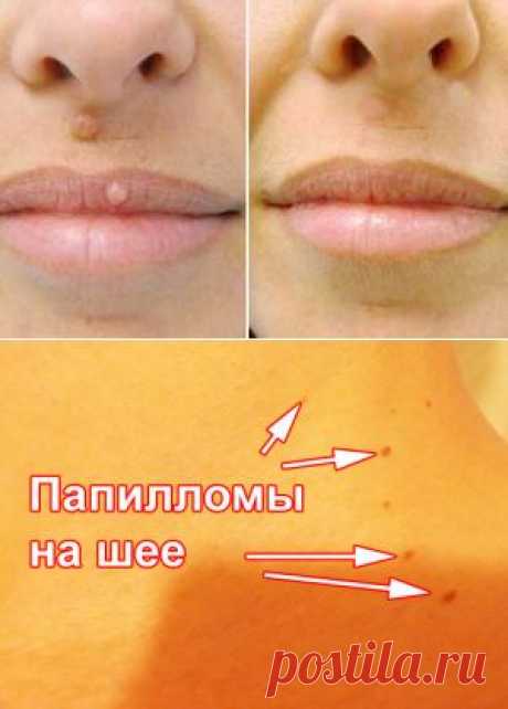 Как избавиться от папиллом и не только