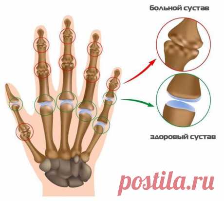 НАРОДНЫЕ СРЕДСТВА ОТ БОЛИ В СУСТАВАХ РУК — Всегда в форме!