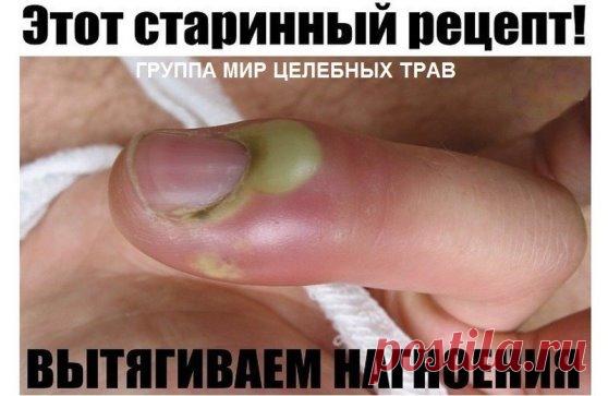 Этот старинный рецепт вытягивает нагноения!
 Вытягивает всю гадость на ура.
Итак, сам рецепт: 
1 ч. л. меда 
1 ст. л. муки 
1 сырой желток 
Перемешиваем и храним в холодильнике. Накладываем на нужное место, сверху укрываем туалетной бумагой. Меняем повязку каждые 3 часа. Ночью можно не менять. Буквально следующий день без всякой боли начинает выходить гной.
Если ранка болезненная, то просто снимаем бумагу, специально ничего не подчищая накладываем новый слой