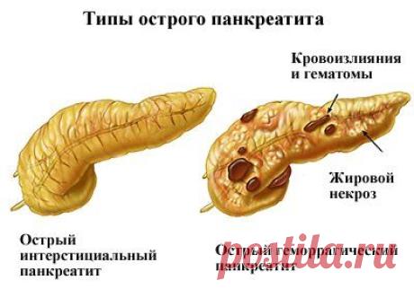 Острый панкреатит - симптомы, лечение и диета