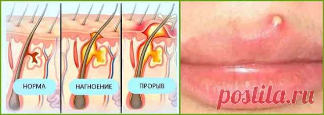 Фурункул – одно из самых распространенных гнойничковых кожных заболеваний, вызванных стафилококком. В быту часто употребляют другое его название – чирей.

Не все части тела могут быть подвержены риску появления этого заболевания. Воспаления волосяной луковицы не возникает там, где нет фолликулов, то есть на ладонях и ступнях. Но чирей чаще возникает на открытых и самых видных местах, поскольку там кожа меньше всего защищена.