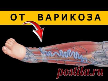Вы должны Посмотреть Как Это Делать. Невозможно Объяснить Как, но Варикоз проходит...