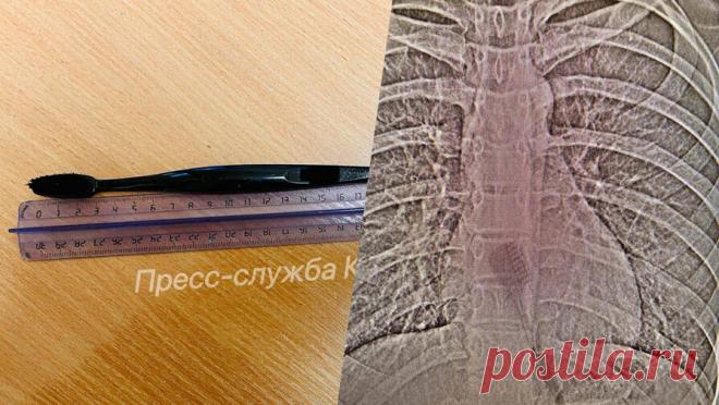 В Татарстане школьница проглотила зубную щетку, когда чистила зубы. В Татарстане врачи извлекли зубную щетку длиной 19 сантиметров из желудка 13-летней девочки. Об этом сообщает пресс-служба Камского детского медицинского центра Набережных Челнов. Девочка поступила в детскую больницу Казани с подозрением ...