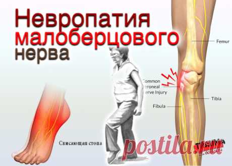 doclvs.ru | Невропатия малоберцового нерва: причины, симптомы, диагностика, лечение
