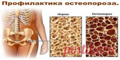 Профилактика остеопороза. Прогрессирующее уменьшение плотности костной ткани, может начаться в очень раннем возрасте. Остеопороз и остеопения могут быть практически у любого человека. Это заболевание поражает кости молодых и старых людей, мужчин и женщин, но в большей степени встречается у женской половины человечества. Такая особенность объясняется тем, что у женщин, по сравнению с мужчинами, костная масса развита меньше. Кроме этого, после наступления менопаузы, когда ум...