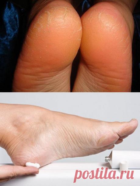 Почему трескаются пятки на ногах? Как их лечить и в чем причина?