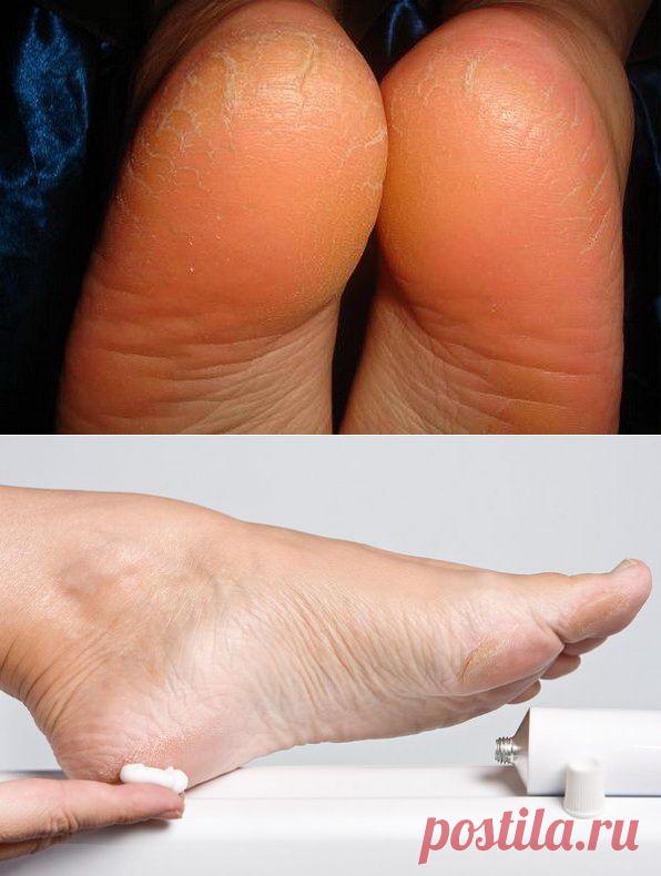 Почему трескаются пятки на ногах? Как их лечить и в чем причина?