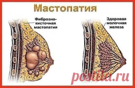 МАСТОПАТИЯ БОИТСЯ ВАЛЕРИАНЫ И ЗВЕРОБОЯ
Услышав от врачей диагноз «мастопатия», многие женщины впадают в отчаяние. И не случайно. Большинство не знает, как это заболевание лечить и как с ним жить. Доктора зачастую никакого лечения не предлагают. Советуют лишь проверять молочные железы каждый год, а вот если уплотнение начнет расти, тогда … придется, видимо, оперировать. Утешение, сами понимаете, слабое. А вот народная медицина знает немало естественных средств, с помощью которых можно облегчить