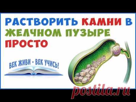 Как растворить Камни в Желчном Пузыре и Печени без операции!