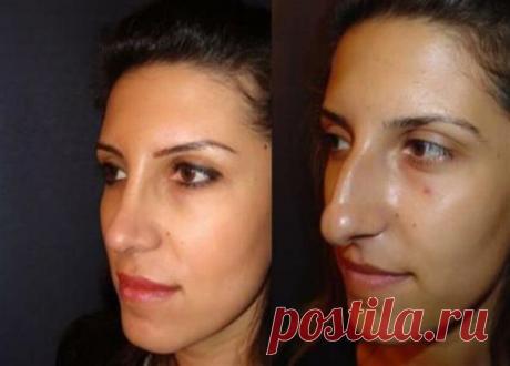 Четыре «за» ринопластику носа | Luxewomen | Яндекс Дзен