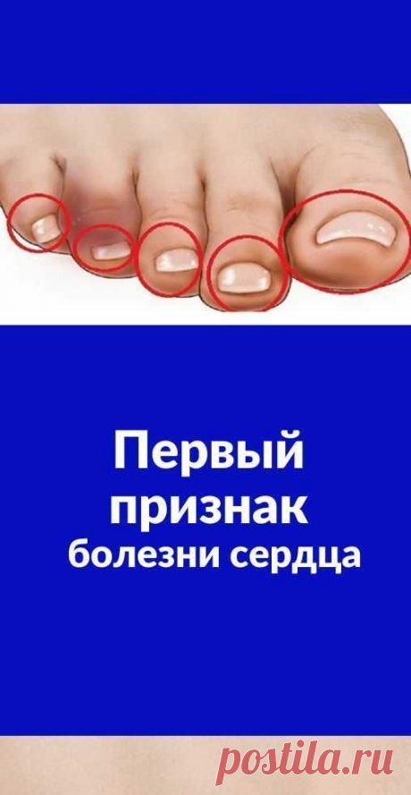 &quot;Тревожный симптом&quot;: на смертельную болезнь сердца укажут ваши ноги! Первый признак болезни сердца Ожирение, курение и сидячий образ жизни — главные враги сердечно-сосудистой системы. Но проблемы с сердцем могут настигнуть даже тех, кто внимательно следит за своим здоровьем…