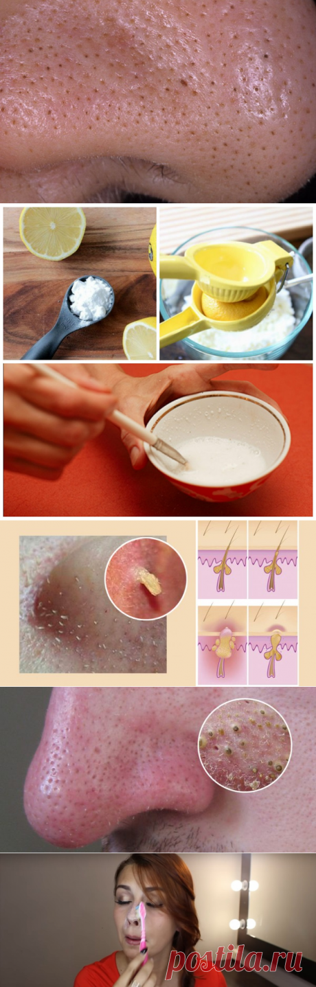 Средство от черных точек
= 1 ч. л. лимонного сока
    1 ч. л. пищевой соды

=Используй его не чаще 1 раза в неделю. Уже после четвертого использования твои поры очистятся и сузятся. После достижения нужного результата прекрати процедуры.