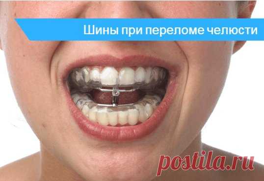 Шинирование при переломе челюсти 🔎 - сколько носят и как снимают шины 💊 Через сколько снимают шину после шинирования зубов нижней челюсти. 🚑 Как питаться при переломе челюсти и наложенной шиной, возможные осложнения и последствия.