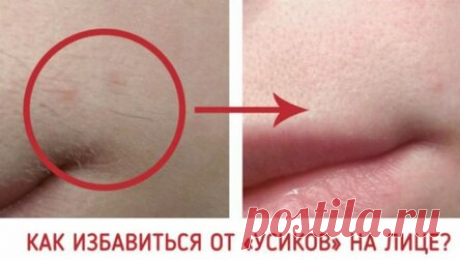 КАК ИЗБАВИТЬСЯ ОТ «УСИКОВ» НА ЛИЦЕ?