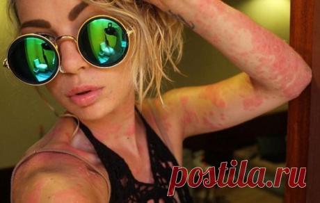 Псориаздың ауыр формалары Псориаздың ауыр формалары үшін кешенді емдеу қолданылады. Ауыр псориаз гомеопатиясы - әртүрлі композициясы бар күрделі препарат. Көбінесе олар басқа да препараттармен, тіпті гомеопатиямен де белгіленеді. Гомеопат осы препараттармен емделуді белгілейді, ал емдеуші дәрігер осы емдеуді түбегейлі немесе басқа емдеу әдістерімен қолдайды.