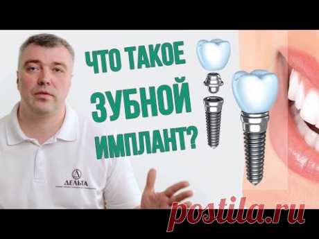Нужно ли устанавливать зубной имплант? (Школа здоровых зубов)