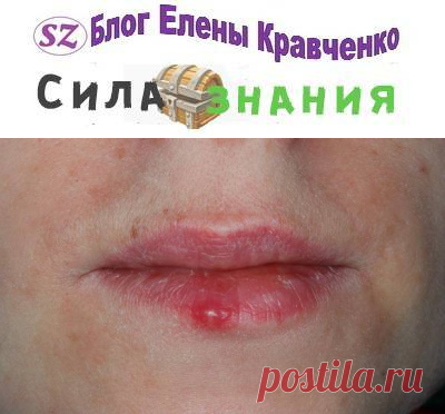Герпес на губах (эффективное быстрое лечение в домашних условиях)