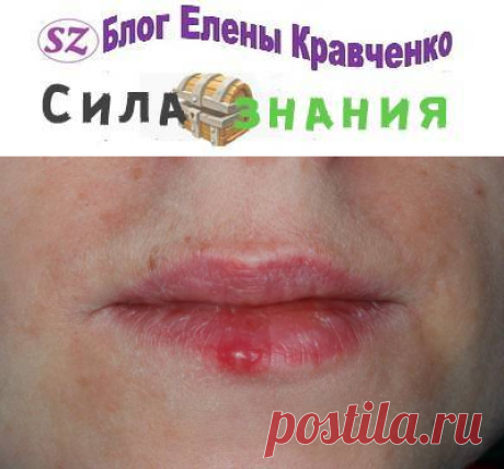 Герпес на губах (эффективное быстрое лечение в домашних условиях)