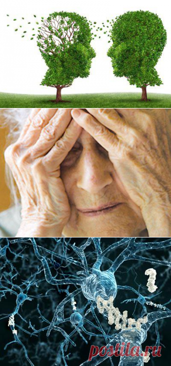 Болезнь Альцгеймера: причины, симптомы и лечение. Болезнь Альцгеймера передается по наследству? :: SYL.ru