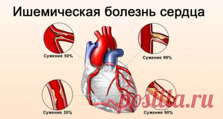 Ишемическая болезнь сердца