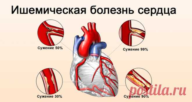 Ишемическая болезнь сердца